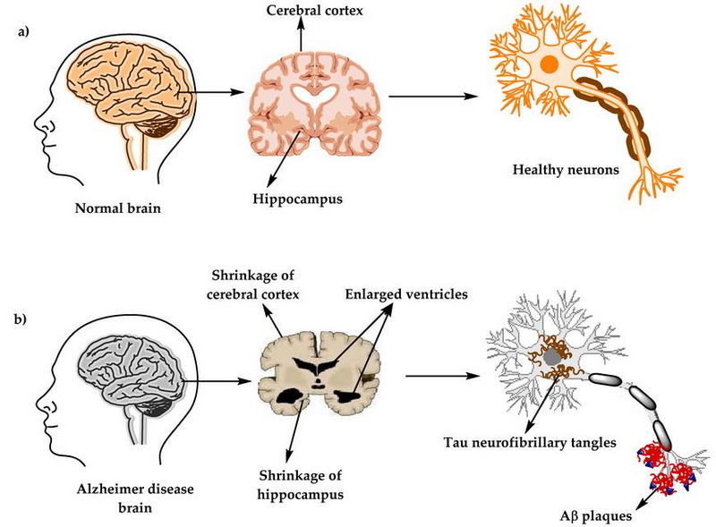 Does Aluminum Oxide Cause Alzheimer's 2