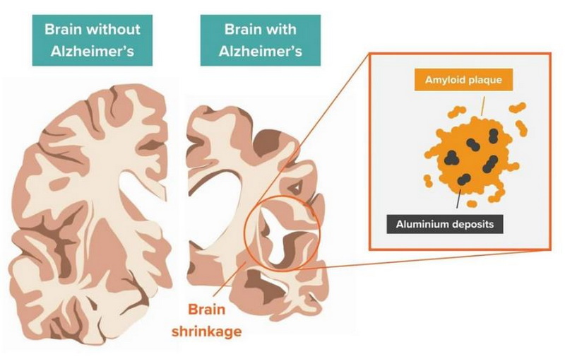 Does Aluminum Oxide Cause Alzheimer's 1